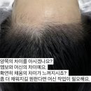 오즈헤어라인 이미지