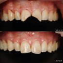 고광택치과의원 | 잠실 앞니 레진, 깨진 앞니 하루만에 치료사례 (서울다루치과) 라미네이트 대신 레진으로 부러진 치아복구