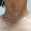 성락약국 | 신사 넘버파이브 클리닉에서 목 , 쇄골 편평사마귀(&amp;쥐젖) 레이저 제거 후기(1일차~3일차,5일차,9일차)