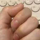 문멍 | 손가락 문 끼임, 손톱 멍, 손톱 빠짐 후기 (새로 자라기까지)