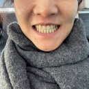 얼굴에미소치과의원 | 치과 안면비대칭 교정 후기, 소름돋는 변화 (비용, 효과)