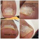 아우룸네일 | 김해 주촌 내성발톱 세심한 풋케어 아우룸79뷰티네일