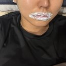 쥬브겔후기 나이 들수록 사라지는 입술이 고민이라 처음 입술필러 받아본 솔직 후기