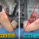 수원골반척추교정