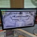 예치과의원 | 교정 중 충치, 신경치료까지.. 그래도 믿고 다니는 인천예치과의원