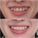 거미스마일 재교정 입술부전증 함입 교정 치료기간 1년 7개월 잇몸미소 클리피씨 치료 후기 사진 기록