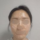 6 | 의정부 편평사마귀 제거 6일차 후기(+리터치 후기)