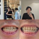 서울 턱관절 치과 반대교합 주걱턱 치아교정 11개월차 후기