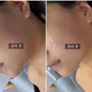 뷰티에이 | 불당동 피부관리 뷰티에이 인퓨즈웨이브 관리 후기