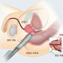 전립선암의 진단 이미지