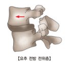 요추 전방전위증 (Lumbar Spondylolisthesis) 이미지