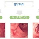 한국인의 질병 '만성위염 유발!' 헬리코박터 파일로리균, 예방 관리법 이미지