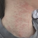 🌞햇빛 알레르기로 미칠 듯한 가려움… 평택 송탄 피부과 봄피부과의원 다녀온 후기(광고아님)