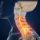 두날개의료기 | 📗[건강] 거북목 vs 목 디스크 차이점과 '넥가드닥터' 사용 후기 - 내돈내산