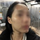 상봉경희한의원 | 피부일기 18일차 두번 째 피부과 피지낭종 제거 후기, 추천 마인드, 경희준한의원, 상봉