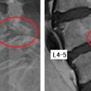 judo90 님의 어머님 요추 L4-5 전방전위증, 협착증 사진 판독입니다. 이미지