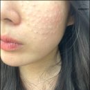 물광주사 효과 시기 기간 유지기간 후기 (+꿀팁)