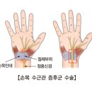 손목 수근관 증후군 (Carpal tunnel syndrome) 이미지