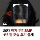 남원장 | 20대 여자 정수리 두피smp 후기 (1년 뒤 모습 공개)
