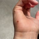 양평맑은피부과의원 네이버블로그