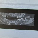 삼주약국 | 미국 뉴욕에서 함치성낭종 매복사랑니 발치 후기 (+삼성화재 글로벌케어 보험금 청구)