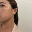 코리아피부관리 | 대구 동성로 피부관리 " 제이라인코리아 " 무통증리프팅 울리프 관리 후기