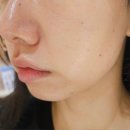 비본영의원 | 성수피부과 비본영의원 내돈내산 미라젯 안티에이징 1회차 후기