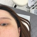 식사동피부관리, 콜드플라즈마 첫 시술 후기 :: 제이유뷰티