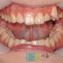 봄길의원 | 잠실교정치과, 1st 어린이 덧니 교정 및 2nd 개방교합과 비대칭 후기