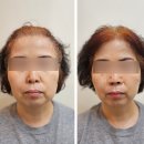 까치산역 피부관리: 라라샵 리프팅 300샷 후기