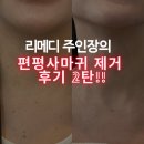 노원-공릉-3394 | [노원토탈뷰티샵] 리메디 원장의 목 편평사마귀 제거부터 회복 과정 후기 / 목 편평사마귀 / 편평사마귀...