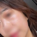 주식회사 아진정보기술 | 대구 동성로 성형외과 리투오 잘하는 곳 | 리투오 스킨부스터 콜라겐 주사 효과 찐 후기