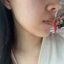 보우치과의원 | 주걱턱 치료 비수술 비발치 7개월차 진행중 효과