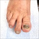 (주)동성메디 | 구로디지털단지발톱무좀 관리 신세계를 경험하다 포쉬네일 동성제약 풀리메디 금천점