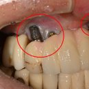 보아치과의원 | 임플란트흔들림 방치하면 안되는 이유 재수술후기 사례로 알아보기