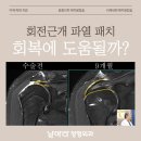 생명과학의원 | 회전근개 파열 패치, 재파열 회복에 정말 도움이 될까?
