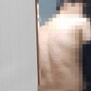 이룸의료기 | 이거 두드러기인가요?? 갑자기 이렇게 두드러기 같은게 생기기 시작했어요 증상은 간지럽기만 하고요...