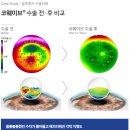 강남라섹후기 / 통증 줄일 수 있어요?