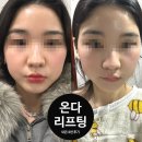 주식회사 다온다옴 | 내돈내산 웨딩관리 강남역 온다리프팅 후기
