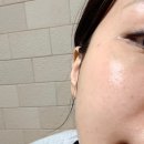 일층약국 | 방배동 피부과 편평사마귀 제거 후기