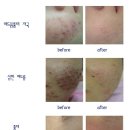 ♬ [에가실크] 활동성.화농성여드름,여드름흉터를 위한 치료법 이미지