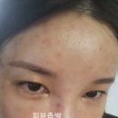 여드름,여드름피부에좋은 피부스킨부스터 엑소좀네오스템 찐후기 (+수면마취,다운타임 경과와 10일차후기)