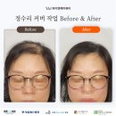 와이앤제이뷰티 - 수원시 영통구 덕영대로1471번길 78 | 수원두피문신 자연스럽게 빈틈 커버한 시술 후기