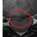 babomp 님의 흉추디스크 MRI사진 판독입니다. 이미지