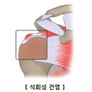 석회성 건염[Calcific Tendinitis]근골격질환 이미지