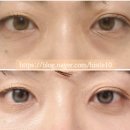 신논현약국 | 신논현 눈밑지 내돈내산 후기 (2탄 수술 과정)