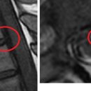SteavePark 님의 흉추디스크 MRI사진 판독입니다. 이미지