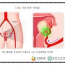 자궁물혹 근종 자궁용종 원인 증상 예방 치료 이미지