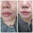 케이메디컬 | 김해피부관리 ｜ 김해 율하 더케이토탈뷰티 여드름 관리 받고 온 솔직 후기