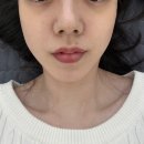 파장 | 헬리오스 마지막 5회차 후기, 파장을 다르게 써보니 토닝치료랑 기미주사까지